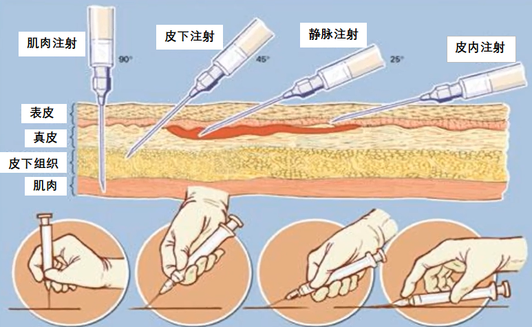 用注射器打針時傷神經(jīng)怎么辦